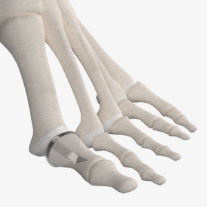 First MPJ Hemi Implant