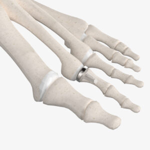 Lesser MPJ Hemi Implant